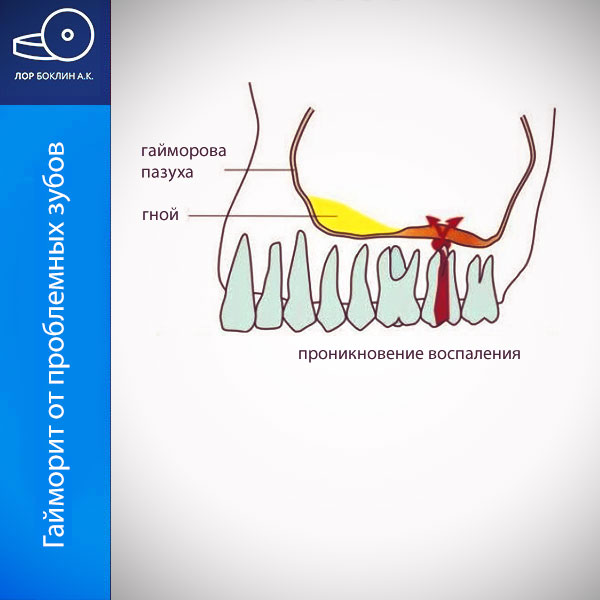 Одонтогенный синусит или гаморит от зубов